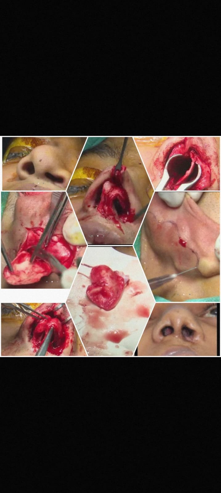 Rhinoplasty before and after